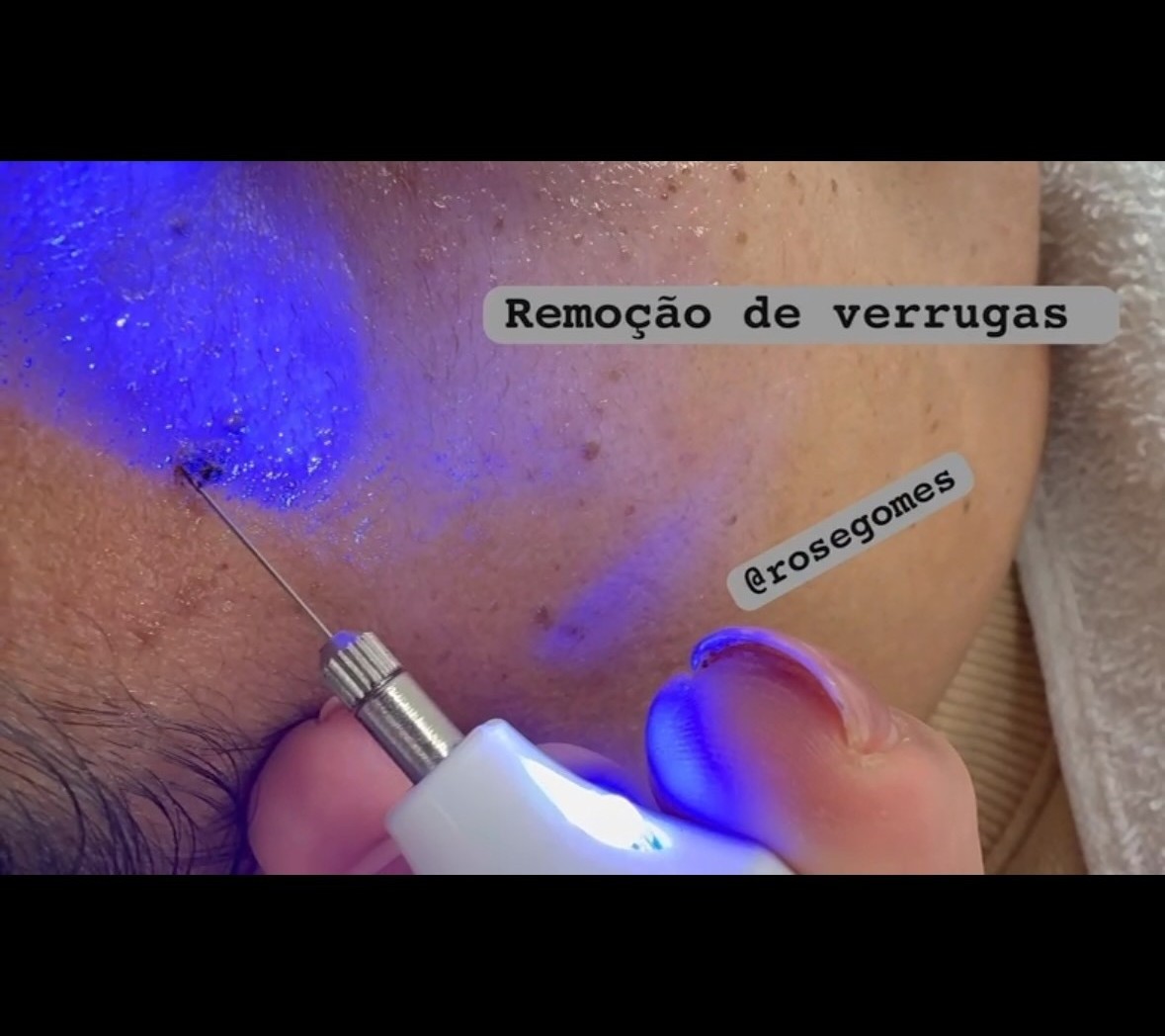 Remoção de verrugas